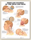 Whiplash Injuries of Head and Neck Anatomical Chart 20" x 26" Laminated