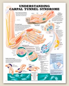 Understanding Carpal Tunnel Syndrome Anatomical Chart 20" x 26" Laminated