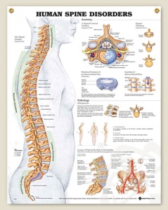 Human Spine Disorders Anatomical Chart 20" x 26" Laminated